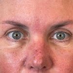 Photo of the patient’s face after the Browlift surgery. Patient 3 - Set 5