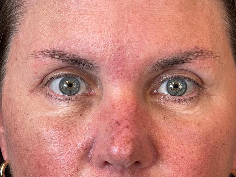 Photo of the patient’s face after the Browlift surgery. Patient 3 - Set 5