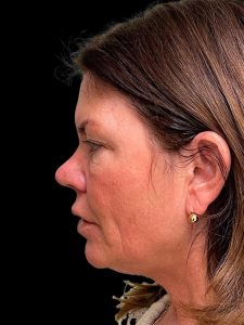 Photo of the patient’s face before the Browlift surgery. Patient 3 - Set 2