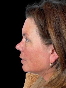 Photo of the patient’s face after the Browlift surgery. Patient 3 - Set 2
