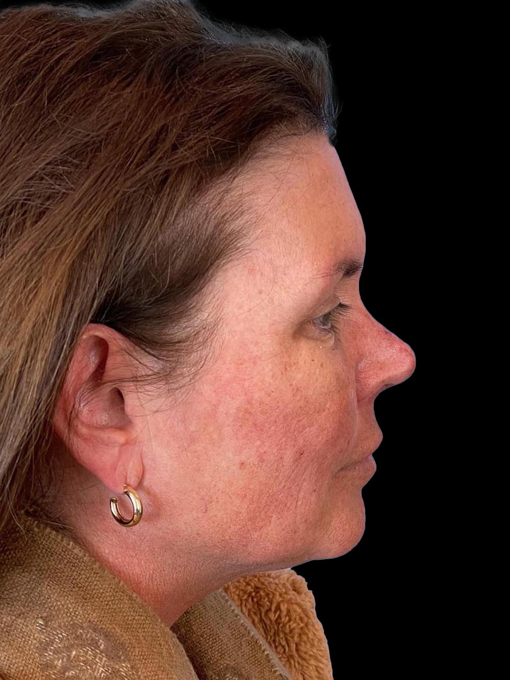 Photo of the patient’s face after the Browlift surgery. Patient 3 - Set 4