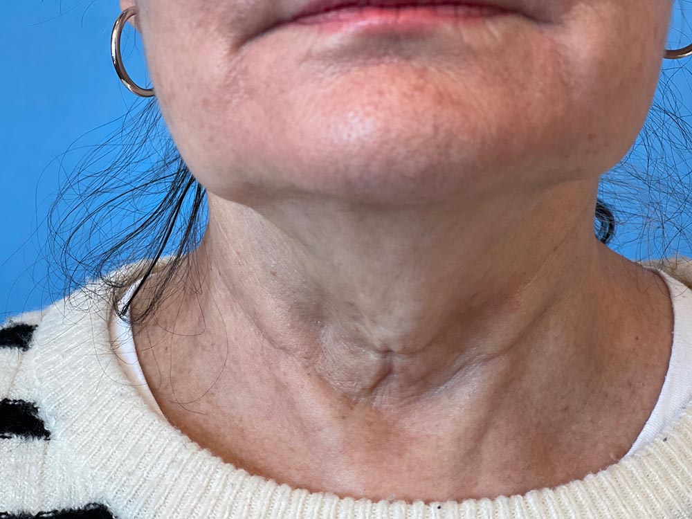 Photo of the patient’s face before the Necklift surgery. Patient 6 - Set 7
