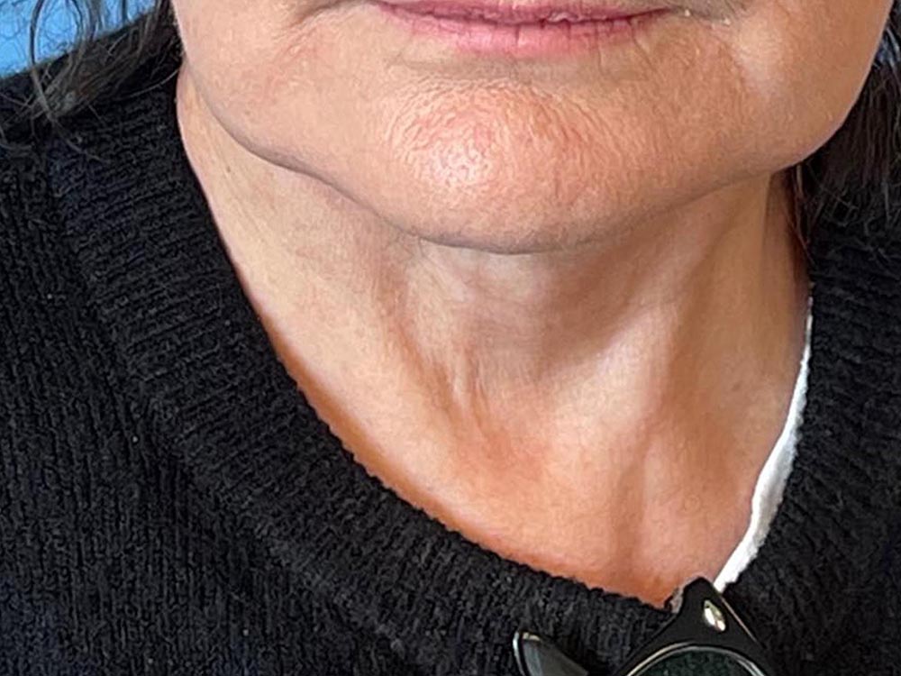 Photo of the patient’s face after the Necklift surgery. Patient 6 - Set 7
