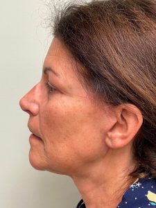 Photo of the patient’s face after the Necklift surgery. Patient 5 - Set 3