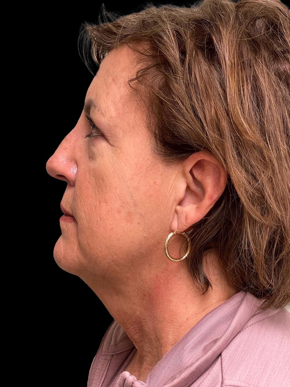 Photo of the patient’s face before the Necklift surgery. Patient 9 - Set 3